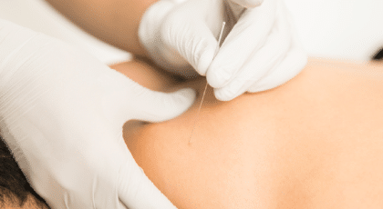 Dry Needling