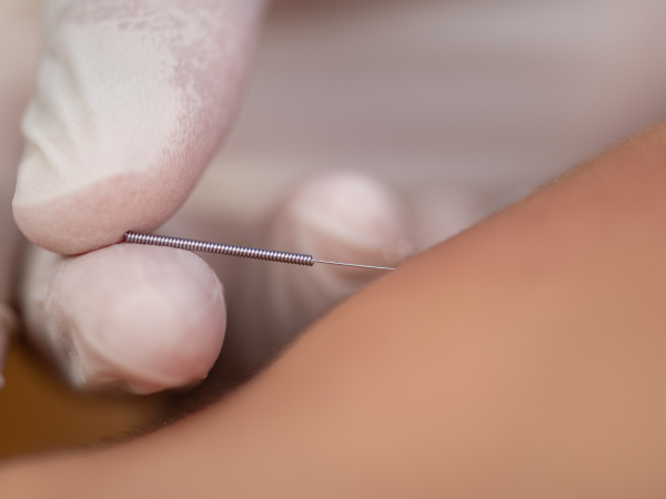 dry needling